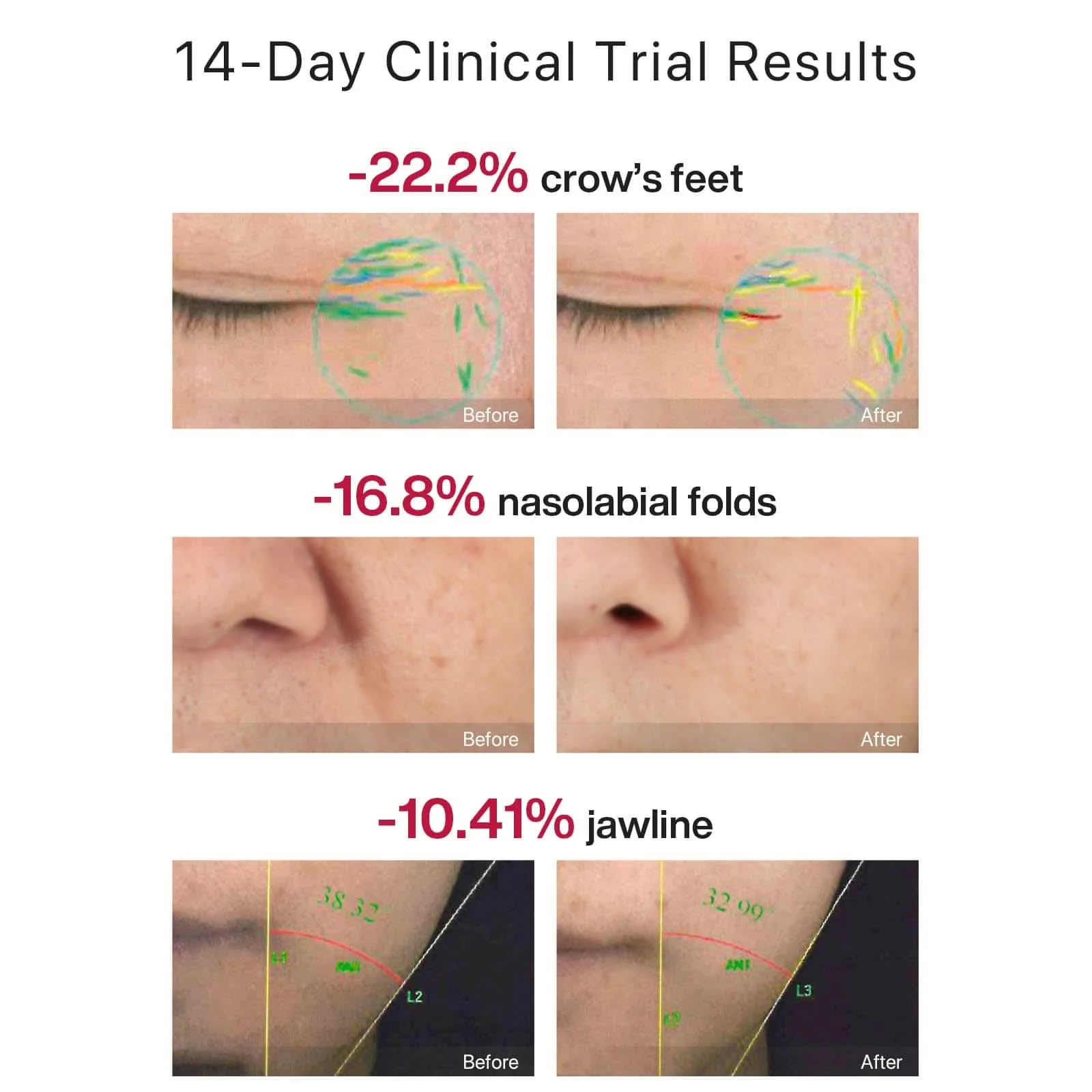 AMIRO R1 PRO RF Skin Tightening Device - Image 3